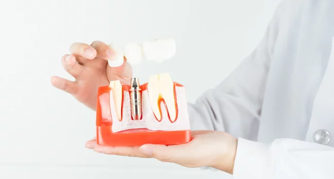 Implantes dentales en Getafe