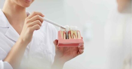 implantes-dentales