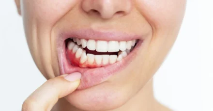 2512-encías-sanas-prevenir-gingivitis-periodontitis